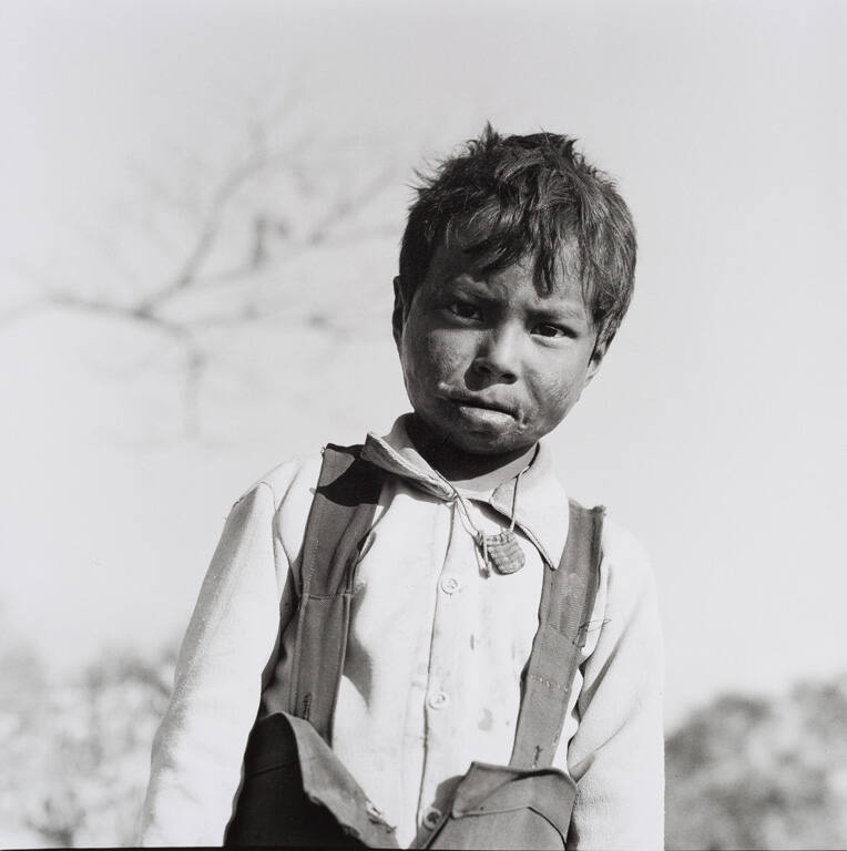 Burned boy with amulet, Kathmandu, Nepal