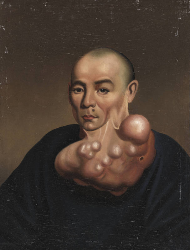 Man with Neurofibroniatosis