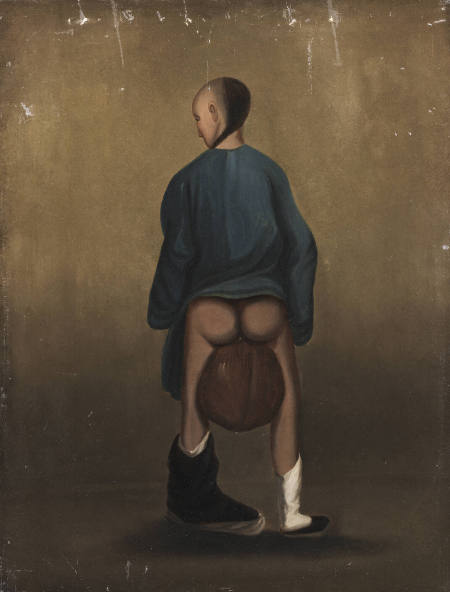 Young Man with Elephantiasis